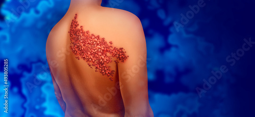Shingles disease viral infection concept as a medical illustration with skin blisters hives and sores on a human back torso as a health symbol for a painful rash condition. photo