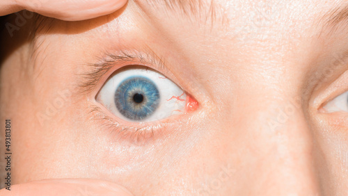 Irritated red bloodshot human eye looking at camera, close-up. Macro photo of blue iris and red veins, vessels on mucous membrane. Concept medicine and health, eye disease photo