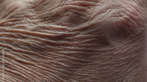 Close Up Of Senior's Hands With Alzheimer Disease