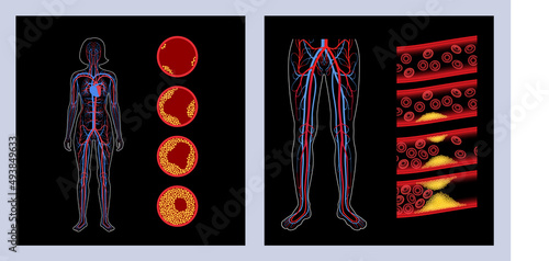 Peripheral artery disease