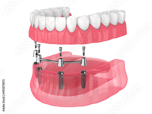 Removable overdenture installation on bar clip attachment, supported by implants