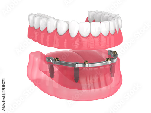 Bar retained removable overdenture installation supported by implants