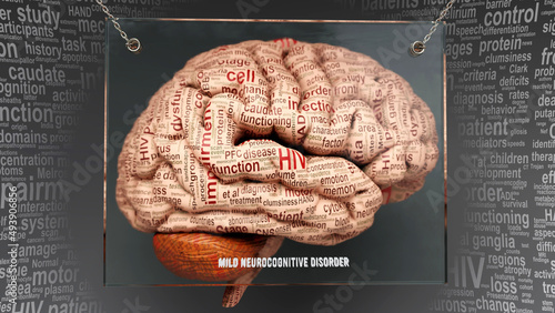 Foto Mild neurocognitive disorder anatomy - its causes and effects projected on a human brain revealing Mild neurocognitive disorder complexity and relation to human mind