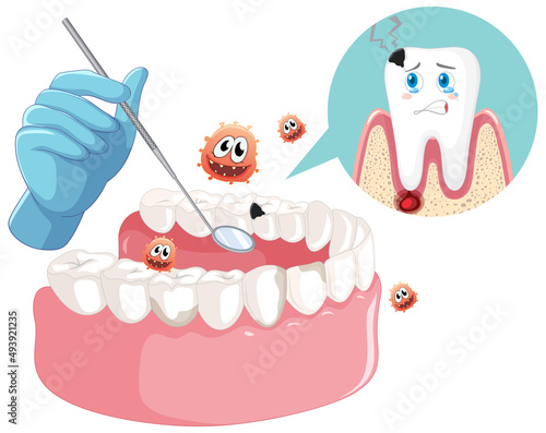 Dentist hand with human teeth decay model