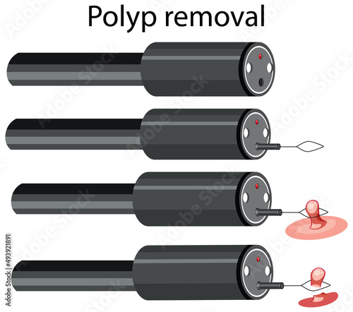 Diagram showing process of polyp removal