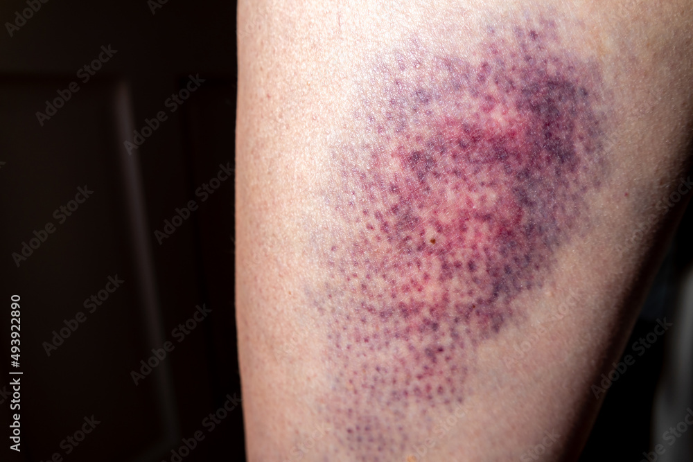 Terrible bruise on the upper leg of a woman Terrible bruise on the upper leg of a woman