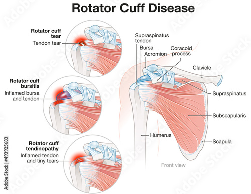 Shoulder Rotator Cuff Disease Illustration. Labeled photo