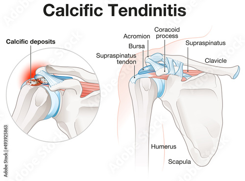 Calcific Tendinitis Shoulder Illustration. Labeled