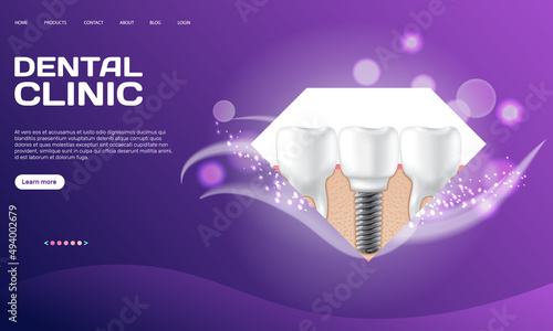 Dental clinic poster vector illustration. Advertising of hospital for teeth treatment. Medical services for installation of dental implant. Human gum with healthy teeth and denture on dentistry banner