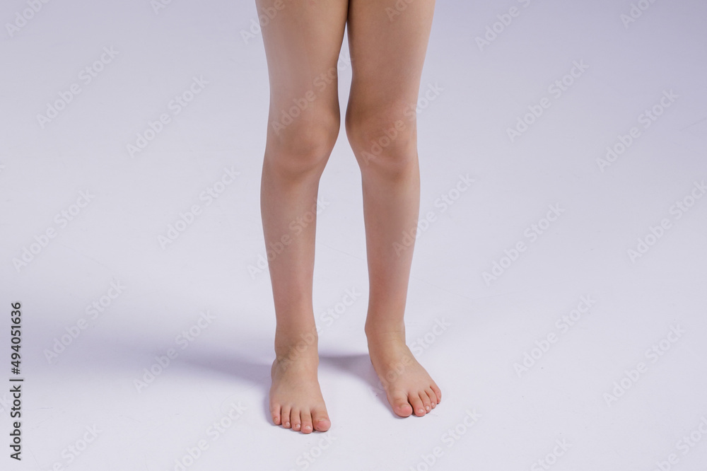 the problem of knee deformity in a child. Legs of a girl close-up with a problem the problem of knee deformity in a child. Legs of a girl close-up with a problem