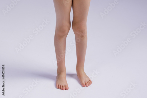 the problem of knee deformity in a child. Legs of a girl close-up with a problem