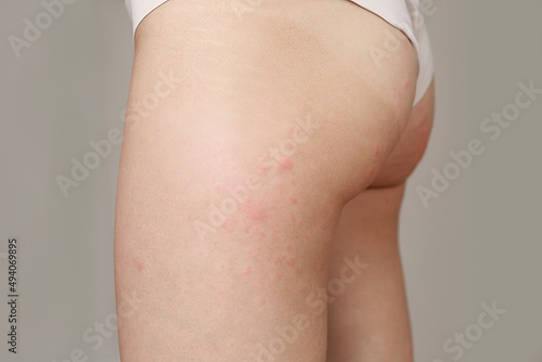 skin allergies, hips skin women. Closeup of red pustules on a hips, an allergic reaction caused by atopic dermatitis. Selected focus