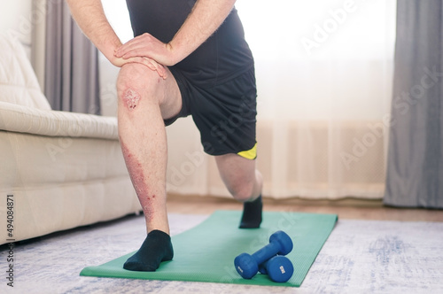 A man does sports exercises at home. There is psoriasis on the leg.
