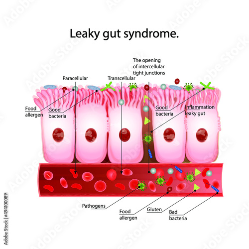 Leaky gut syndrome. Healthy cells and inflamed intestinal cells.Paracellular and  Transcellular transport route.