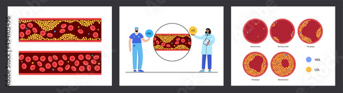 Cholesterol blood artery