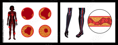 Peripheral artery disease