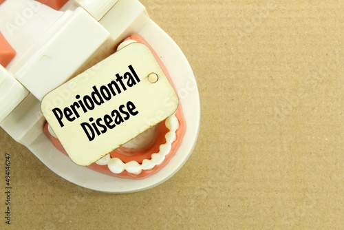 human tooth models and wooden tags with the word periodontal disease photo