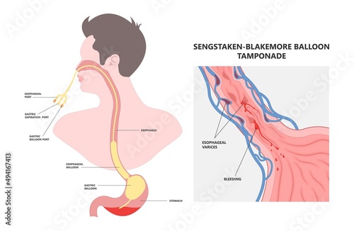 Weiss tear upper gastric ulcer portal liver veins clot blood stools scarring A B fatty bile duct alcohol exam band variceal fibrosis Oesophageal GI Nursing care swollen blocked varicose