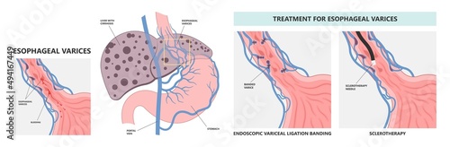 Weiss tear upper gastric ulcer portal liver veins clot blood stools scarring A B fatty bile duct alcohol exam band variceal fibrosis Oesophageal GI Nursing care swollen blocked varicose