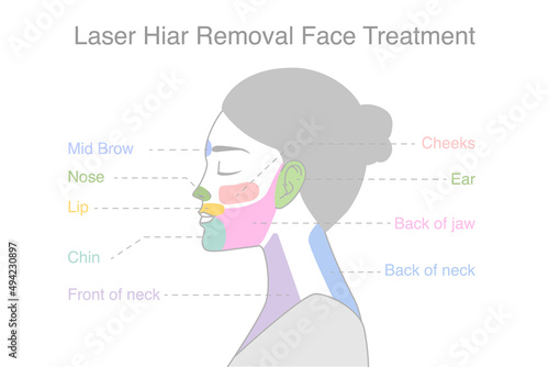 Highlight on woman's face area to do laser hair removal treatments. Illustration about diagram for a beauty treatment with laser.