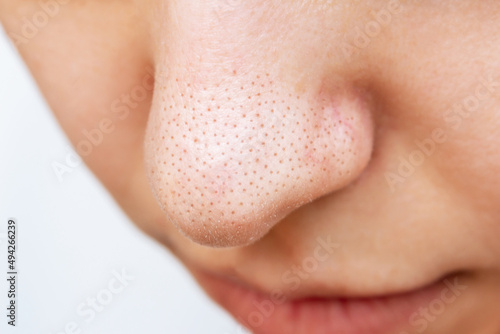 Close-up of a woman's nose with black heads or black dots isolated on a white background. Acne problem, comedones. Enlarged pores on a face. Cosmetology dermatology concept. Blackheads on greasy skin