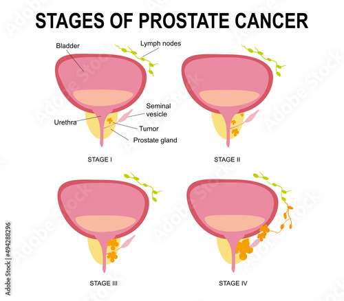 Stages of prostate cancer.Destruction of the male gland with its development into a malignant tumor with impaired reproductive function and blockage of the urethra.Infographics, urology.Medical, flat 