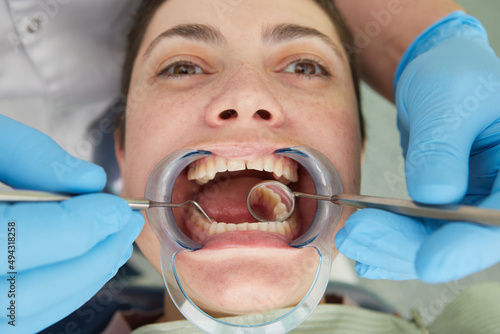 Photos Close up of patient with cheek retractor in mouth receiving dental treatment