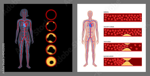 Cholesterol and atherosclerosis
