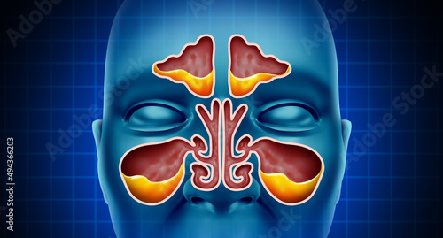 Cuadro en lienzo Sinus Infection and Sinusitis illness as a nasal cavity blockage disease with a