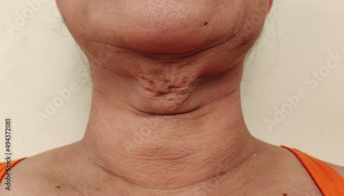 Portrait showing the flabbiness adipose hanging under the neck  problem wrinkled under the chin  concept health care.