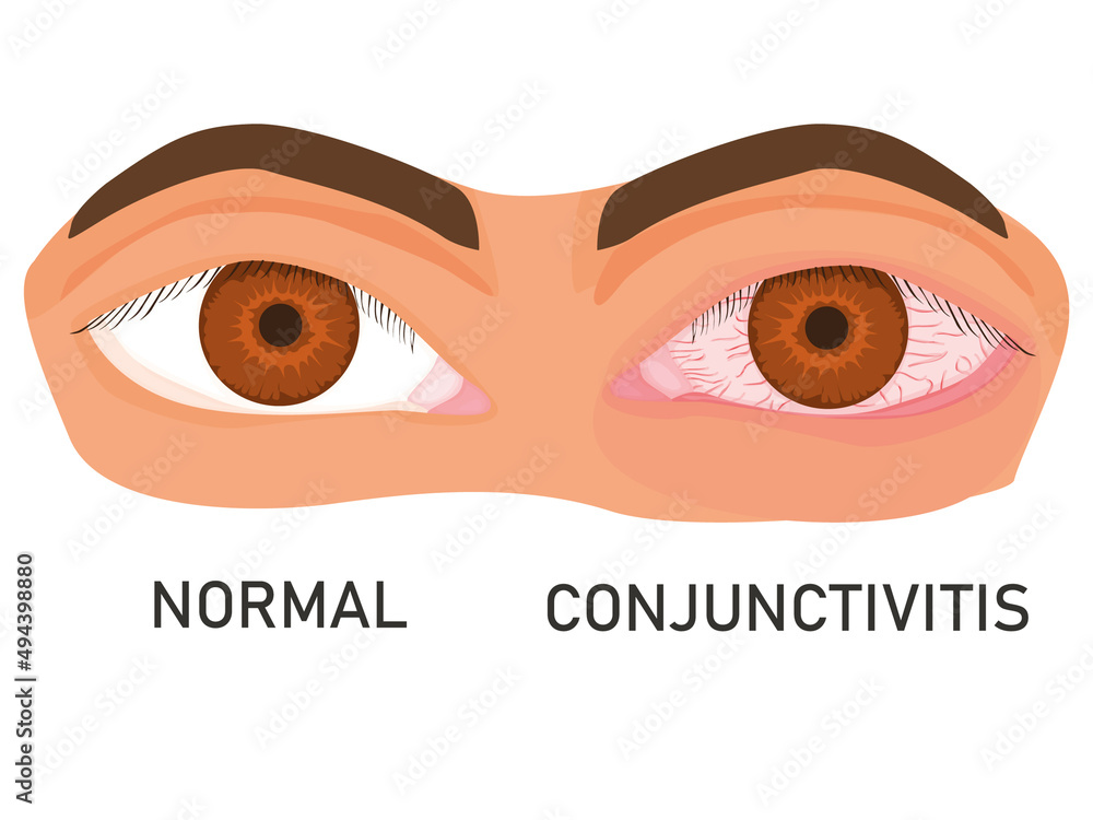 illustration of eyes with mucous membrane irritation. healthy eye and