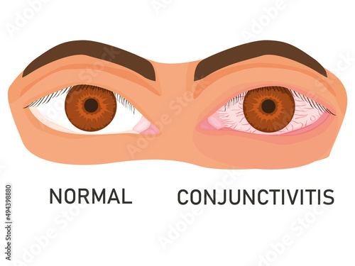 illustration of eyes with mucous membrane irritation. healthy eye and with conjunctivitis. inflammation of the mucous membrane of the eye. flat vector on white background