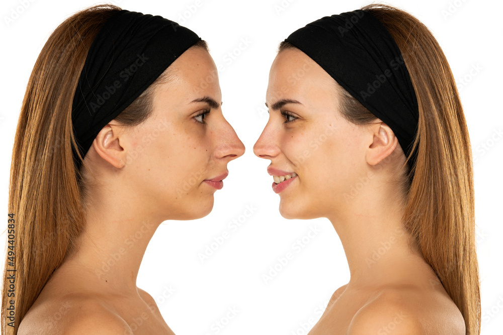 Comparison of female nose, before and after plastic surgery Comparison of female nose, before and after plastic surgery