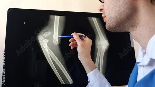 Man radiologist analysing a patient arm and forearm bones x ray with a humerus fracture.