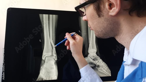 Man radiologist analysing a football player patient x ray with a fibula fracture.
