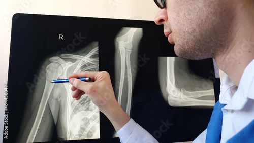 Man radiologist analysing a patient arm and forearm bones x ray with a humerus fracture.