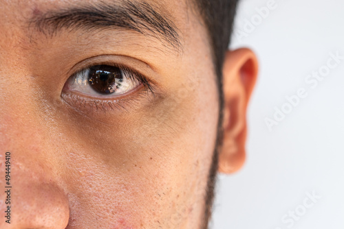 Close up of unhealthy Asian man having under-eye problem such as dark circles and puffiness. Using a collagen hydro gel under-eye mask can allow the skin to be soaked in moisture.