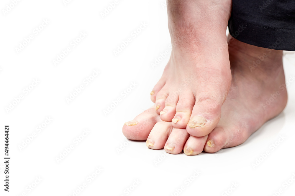 Nail fungus on legs disease. Fungal infection on nails legs, finger