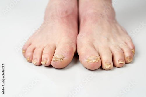 Nail fungus on legs disease. Fungal infection on nails legs, finger with onychomycosis, damage on human legs.