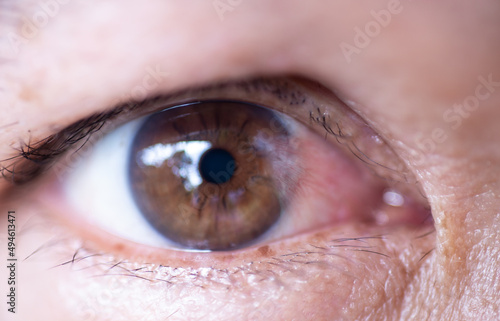 The eyes of people with cataract, a disease of the eye.	 photo