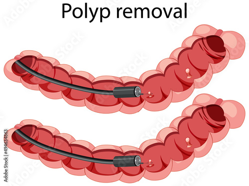 Diagram showing polyp removal