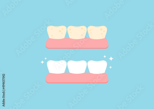 Tooth bleaching health and tooth with yellow plaque before, after icon set. Teeth stain cleaning, whitening concept. Flat design cartoon vector illustration. Dental oral hygiene stained teeth