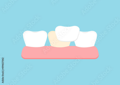 Tooth health and tooth with orthodontic veneer icon. Teeth aesthetic treatment, cleaning, ceramic crown color restoration concept. Flat cartoon vector illustration. Dental oral hygiene