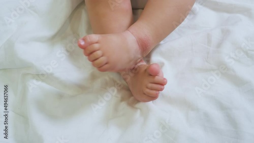 Legs of a small child are atopic. Atopic dermatitis of the skin on legs of a newborn baby. Small baby lies on a white sheet for up to a year and rubs his legs. Close-up of reddened legs. photo