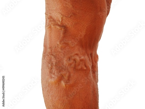 The severity of the varicose veins ranges from the tiny capillaries  pain in the legs  swollen feet and legs  and the crooked aneurysm resembles a worm.