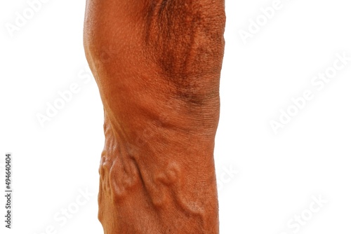 The severity of the varicose veins ranges from the tiny capillaries, pain in the legs, swollen feet and legs, and the crooked aneurysm resembles a worm. photo