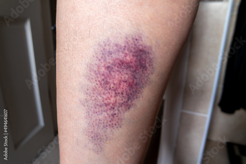 Obraz na plátne Terrible bruise on the upper leg of a woman