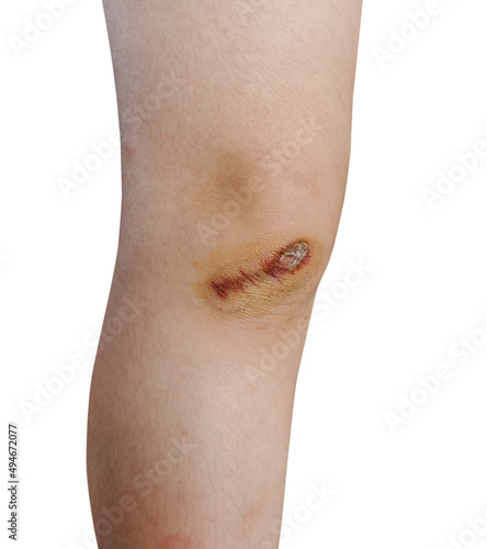 Scar and scab (eschar) on the knee