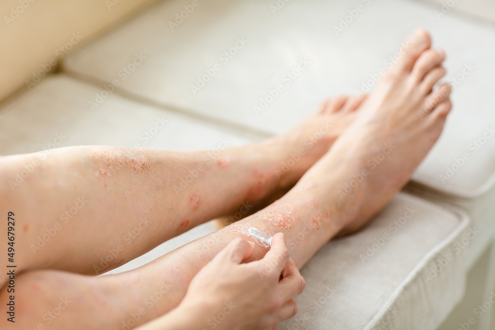 applying an emollient cream to dry flaky skin as in the treatment of psoriasis, eczema and other dry skin conditions applying an emollient cream to dry flaky skin as in the treatment of psoriasis, eczema and other dry skin conditions