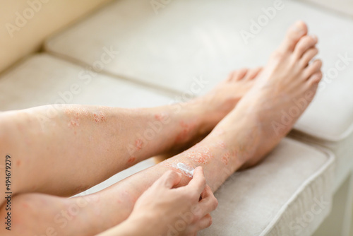 applying an emollient cream to dry flaky skin as in the treatment of psoriasis, eczema and other dry skin conditions photo